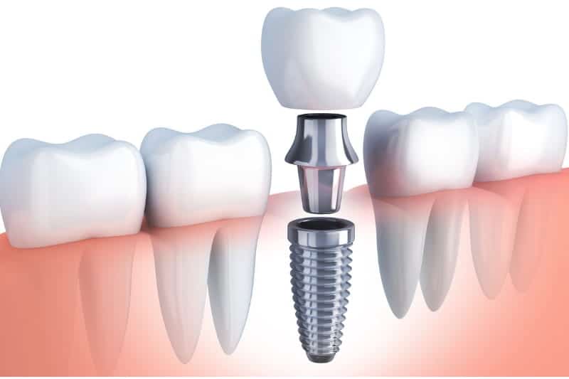 Immediate load implants abroad